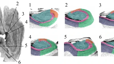 Curved Multiplanar Reformatting Provides Improved Visualization of Hippocampal Anatomy. featured image