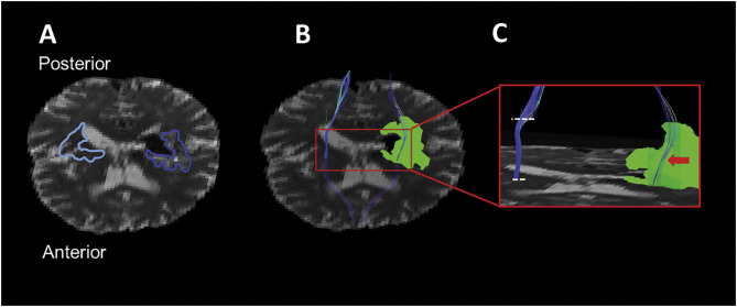 Figure for Peri-Hematoma Corticospinal Tract Integrity in Intracerebral Hemorrhage Patients: A Diffusion-Tensor Imaging Study.