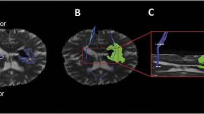Peri-Hematoma Corticospinal Tract Integrity in Intracerebral Hemorrhage Patients: A Diffusion-Tensor Imaging Study. featured image