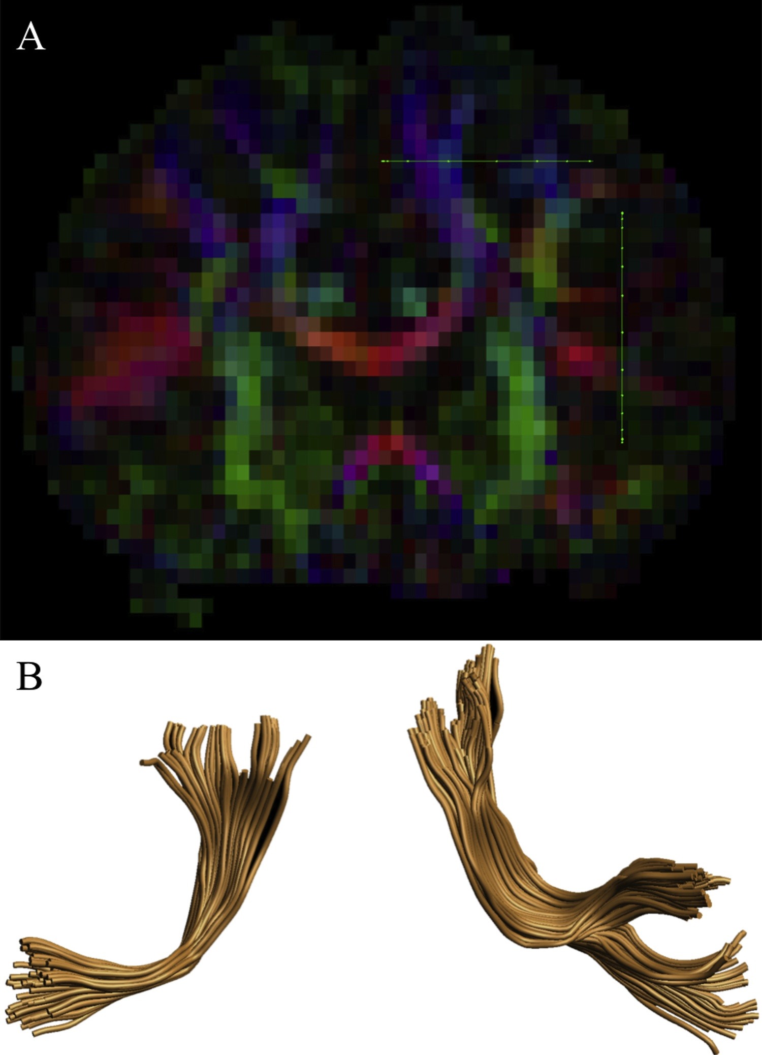 Figure for White Matter Tractography of the Neural Network for Speech-Motor Control in Children Who Stutter.