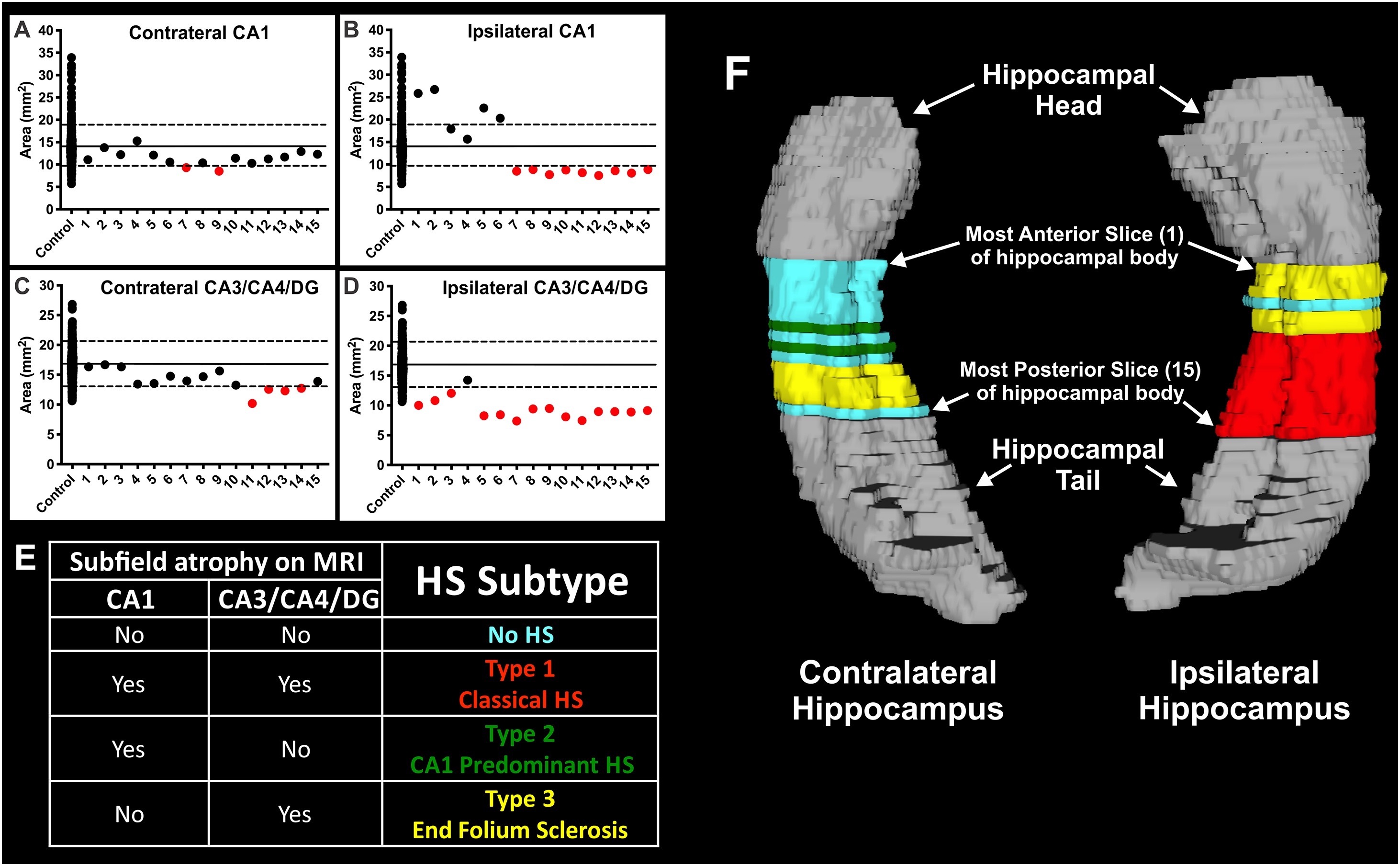 Figure for Hippocampal Subfield Measurement and ILAE Hippocampal Sclerosis Subtype Classification with in Vivo 4.7 Tesla MRI.